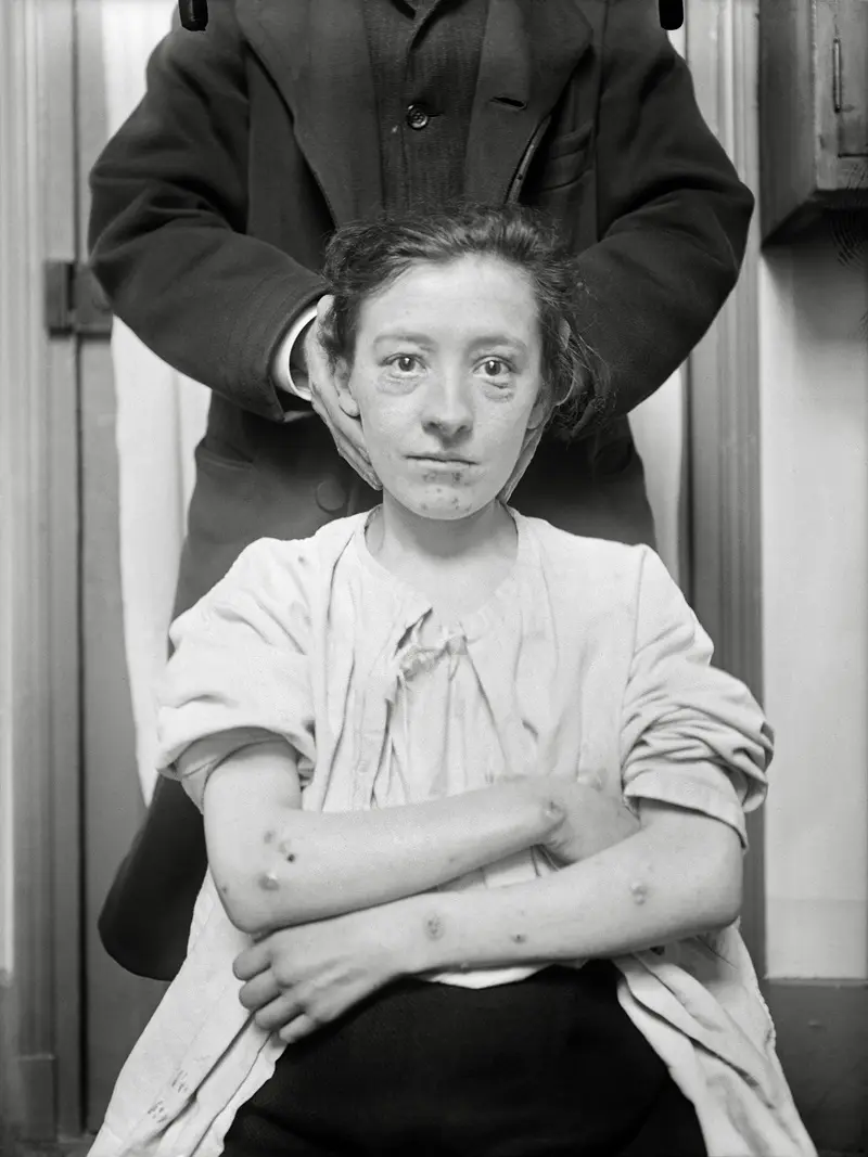 Charles Lhermitte [1881-1945] Folles de la Salpêtrière Négatifs au gélatino-bromure d’argent sur verre Vers 1910 Collection du musée Nicéphore Niépce