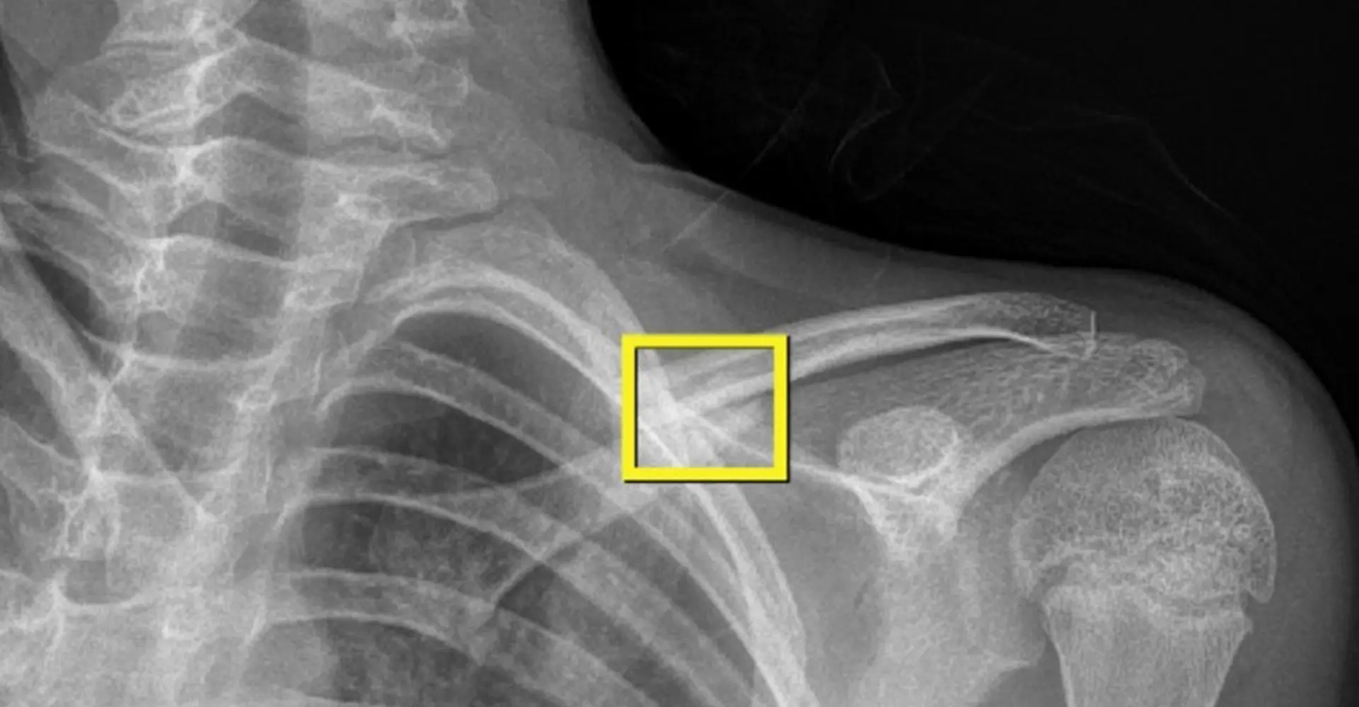 Fracture de l'épaule