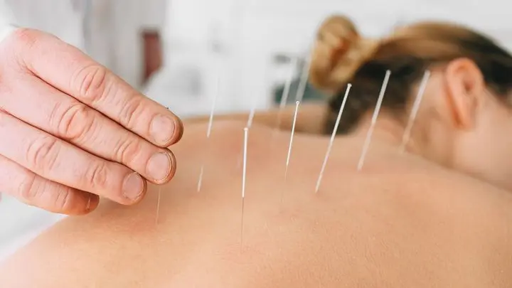 acupuncture
