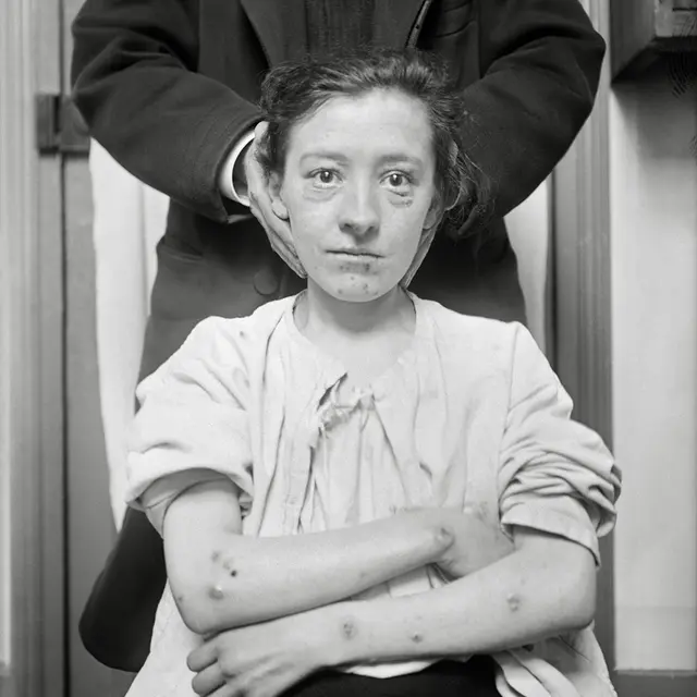 Charles Lhermitte [1881-1945] Folles de la Salpêtrière Négatifs au gélatino-bromure d’argent sur verre Vers 1910 Collection du musée Nicéphore Niépce