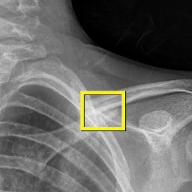 Fracture de l'épaule