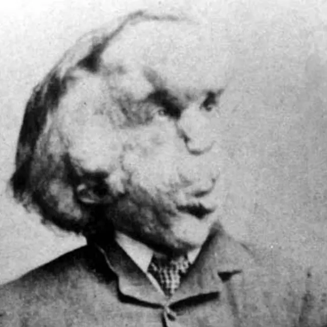 Elephant man, l'histoire de Joseph Merrick